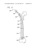 EXPANDABLE BLADE DEVICE FOR STABILIZING LONG BONE FRACTURES diagram and image