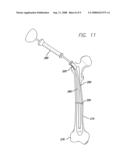 EXPANDABLE BLADE DEVICE FOR STABILIZING LONG BONE FRACTURES diagram and image