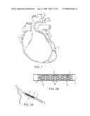 STENT SYSTEMS diagram and image