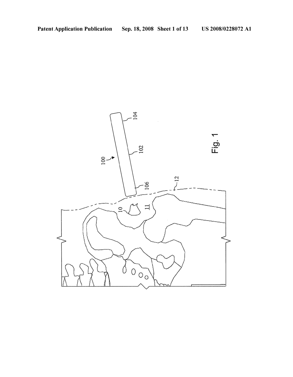 Foreign Body Identifier - diagram, schematic, and image 02