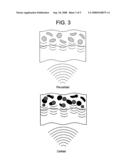 CLINICAL UTILIZATION OF CONTRAST AGENTS TO DEFINE SPECIFIC AREAS WITHIN THE MYOCARDIAL WALL TO PROVIDE GUIDANCE AND LOCALIZATION FOR ABLATION, CYROABLATION, OR OTHER TECHNIQUES IN PATIENTS WITH POST MYOCARDIAL INFARCTION diagram and image