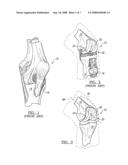 Distal femoral cutting guide diagram and image