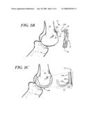 IN SITU PATELLAR FIXING SYSTEM diagram and image