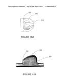 INTRALUMENAL MATERIAL REMOVAL USING A CUTTING DEVICE FOR DIFFERENTIAL CUTTING diagram and image