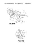 Interlaminar-Interspinous Vertebral Stabilization System diagram and image