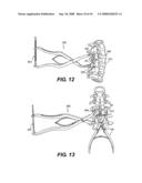 Interlaminar-Interspinous Vertebral Stabilization System diagram and image