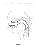 Oropharyngeal Airway Device diagram and image