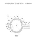 EXTENDED THERAPEUTIC EFFECT OCULAR IMPLANT TREATMENTS diagram and image