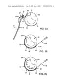 DEVICES AND METHODS FOR HEART VALVE REPAIR diagram and image