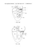 DELIVERY DEVICES AND METHODS FOR HEART VALVE REPAIR diagram and image