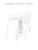 DEVICES AND METHODS FOR HEART VALVE REPAIR diagram and image