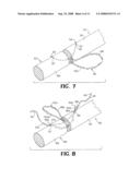 SUTURE ANCHOR AND METHOD diagram and image