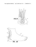 SUTURE ANCHOR AND METHOD diagram and image