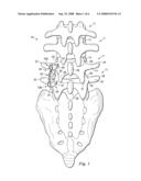 Vertebral Stabilizer diagram and image