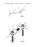 Spinal stabilization device diagram and image