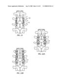 Spinal stabilization device diagram and image