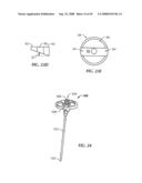 Spinal stabilization device diagram and image