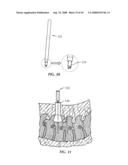 Spinal stabilization device diagram and image