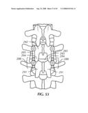 Spinal stabilization device diagram and image