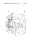 Surgical plate puller devices and methods for use with surgical bone screw/plate systems diagram and image