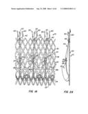 Low Profile Heart Valve and Delivery System diagram and image