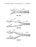 Low Profile Heart Valve and Delivery System diagram and image