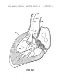 Low Profile Heart Valve and Delivery System diagram and image