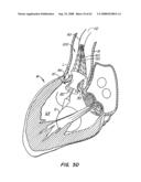 Low Profile Heart Valve and Delivery System diagram and image