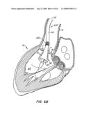 Low Profile Heart Valve and Delivery System diagram and image