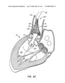 Low Profile Heart Valve and Delivery System diagram and image