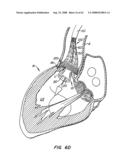 Low Profile Heart Valve and Delivery System diagram and image