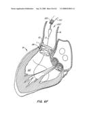 Low Profile Heart Valve and Delivery System diagram and image