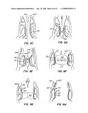 Low Profile Heart Valve and Delivery System diagram and image