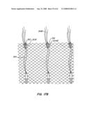 Low Profile Heart Valve and Delivery System diagram and image