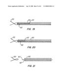 Low Profile Heart Valve and Delivery System diagram and image