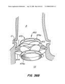 Low Profile Heart Valve and Delivery System diagram and image