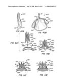 Low Profile Heart Valve and Delivery System diagram and image