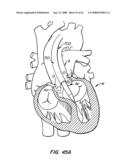 Low Profile Heart Valve and Delivery System diagram and image