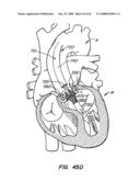 Low Profile Heart Valve and Delivery System diagram and image