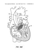 Low Profile Heart Valve and Delivery System diagram and image