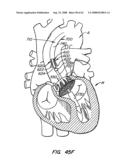 Low Profile Heart Valve and Delivery System diagram and image