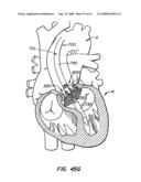 Low Profile Heart Valve and Delivery System diagram and image