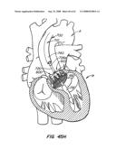 Low Profile Heart Valve and Delivery System diagram and image