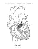 Low Profile Heart Valve and Delivery System diagram and image