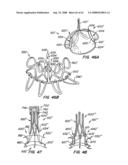 Low Profile Heart Valve and Delivery System diagram and image