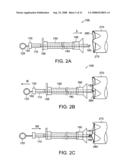 Gastrointestinal implant with drawstring diagram and image