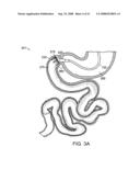 Gastrointestinal implant with drawstring diagram and image