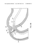 Gastrointestinal implant with drawstring diagram and image