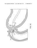 Gastrointestinal implant with drawstring diagram and image