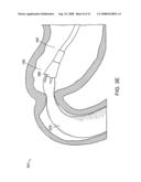 Gastrointestinal implant with drawstring diagram and image